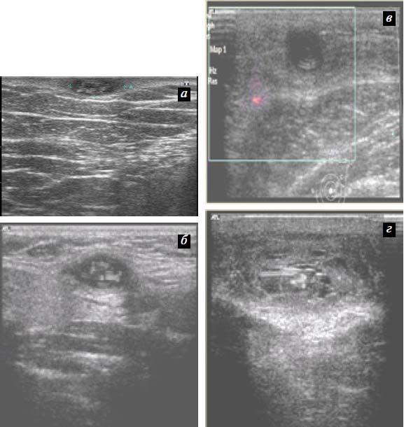 Рис. 3. Эхограммы пациенток В., 36 лет (а), Д., 40 лет (б), У., 47 лет (в), О., 55 лет (г), с паразитарными кистами