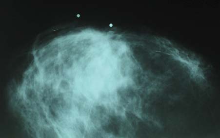 Рис. 5. Рентгенограмма пациентки Н., 43 года, с туберкулезом правой грудной железы (прямая проекция)