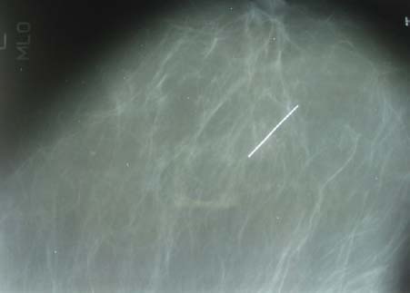 Рис. 6. Рентгенограмма пациентки Р., 46 лет, с металлической иглой в левой грудной железе (прямая проекция)
