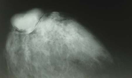 Рис. 8. Рентгенограмма пациентки П., 68 лет, с сифилитической гуммой в правой грудной железе (прямая проекция)