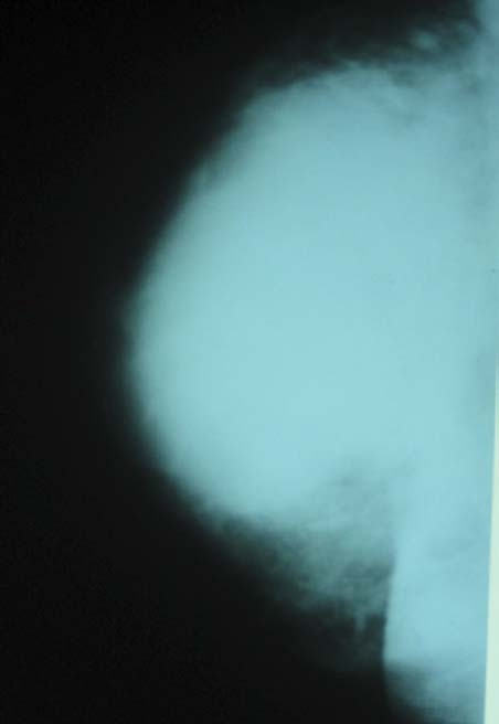 Рис. 9. Рентгенограмма пациентки Т., 42 года, с абсцессом правой грудной железы (косая проекция)