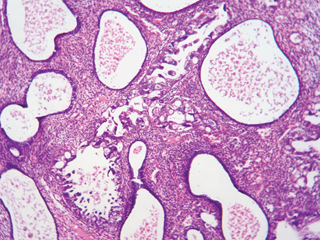Рис. 2. В отдельных железах атрофичная эпителиальная выстилка замещена атипичными полиморфными клетками. Окраска гематоксилином и эозином, х200