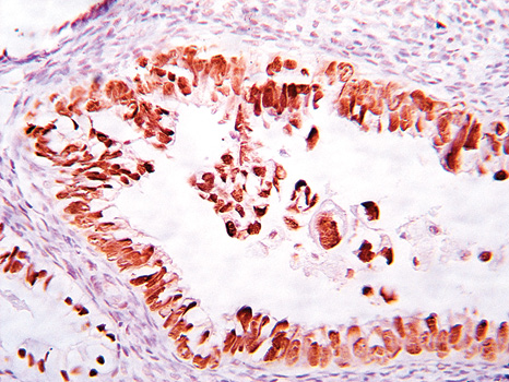 Рис. 4. Позитивная ядерная реакция на наличие экспрессии белка р53. Иммуногистохимическое окрашивание, клон DO-7, производитель Dako, система визуализации EnVision, chromogene DAB, х400