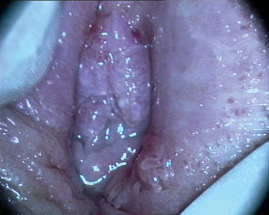 Рис. 9. Кольпофотограма. x6. Кондиломатозне ураження малих статевих губ