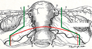 Рис. 1. Схематичне зображення гістеректомії ІІІ типу та трахелектомії