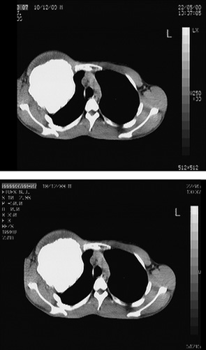 Рис. 1. Томограма пацієнта з хонд­росаркомою