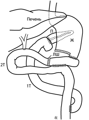 Рис. 3. Методика изолированной реконструкции: П — поджелудочная железа; Ж — желудок; 1Т — первая петля тонкого кишечника; 2Т — вторая петля тонкого кишечника; ЛШ — линия шва заглушки приводящей петли
