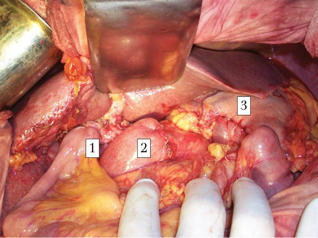 Рис. 4. Методика изолированной реконструкции — окончательный вид: 1 — гепатикоеюноанастомоз; 2 — панкреатоеюноанастомоз; 3 — гастроэнтероанастомоз