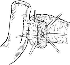 Рис. 1. Анастомоз Blumgart [35]: единичные циркулярные швы изнутри панкреатического протока сквозь всю толщу поджелудочной железы