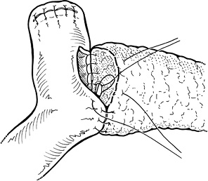 Рис. 1. Анастомоз Blumgart [35]: единичные циркулярные швы изнутри панкреатического протока сквозь всю толщу поджелудочной железы