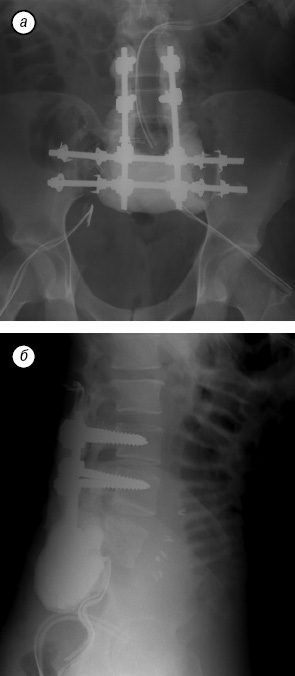 Рис. 12. Рентгенограммы после операции: а — фронтальная плоскость; б — сагиттальная плоскость