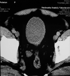 Рис. 2. КТ та МРТ хворого Н. після проведення ПХТ. Контури сечового міхура рівні, чіткі, незначне потовщення задньої стінки. МРТ — магнітно-резонансна томографія 
