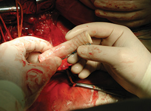 Рис. 3. Аллотрансплантация лиофилизированной трахеи. Подготовленный к пересадке лиофилизированный аллотрансплантат
