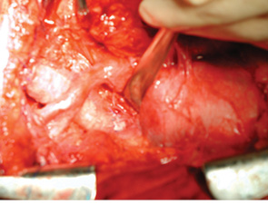 Рис. 4. Аллотрансплантация лиофилизированной трахеи. Конечный вид после пересадки трахеи