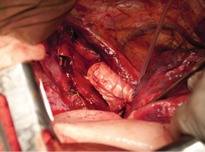 Рис. 7. Аллотрансплантация деиммунизированной трахеи с бронхами. Формирование обоих бронхиальных анастомозов закончено