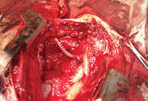 Рис. 9. Протезирование магистральных сосудов в онкохирургии. Протезирование подключичной артерии после удаления опухоли верхней грудной апертуры