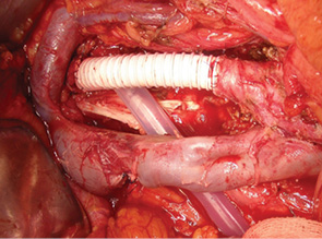 Рис. 10. Протезирование магистральных сосудов в онкохирургии. Протезирование аорты после удаления забрюшинных метастазов герминогенной опухоли