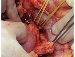 Рис. 4. Выделение правой почечной артерии и правой почечной вены с участком нижней полой вены для аутотрансплантации