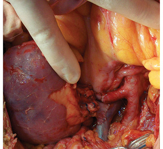 Рис. 6. Формирование сосудистых анастомозов: почечная артерия в прокси­мальной культи левой внутренней подвздошной артерии («конец в конец»), почечная вена с левой наружной подвздошной веной («конец в бок»)