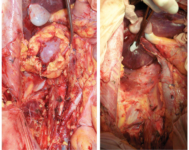 Рис. 8. Правый абдоминальный фланк до и после аутотрансплантации почки и тщательного тотального удаления забрюшинной клетчатки