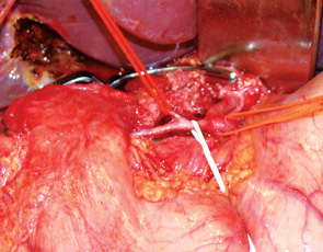 Рис. 1. Выделение задней верхней панкреатодуоденальной артерии. На держалки взяты гастродуоденальная артерия, задняя верхняя панкреатодуоденальная артерия, общая печеночная артерия