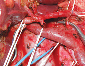 Рис. 2. Выделение основного ствола дорзальной панкреатической артерии (под него подведен диссектор) во время выполнения лимфаденэктомии вокруг чревного ствола