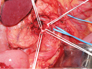 Рис. 3. Панкреатодуоденальная резекция с селективной перевязкой нижней панкреатодуоденальной артерии – CLIP Method. На синей держалке – верхняя брыжеечная вена, на белых держалках – верхняя брыжеечная артерия, панкреатодуоденоеюнальный ствол, нижняя панкреатодуоденальная артерия, верхняя тонкокишечная артерия  