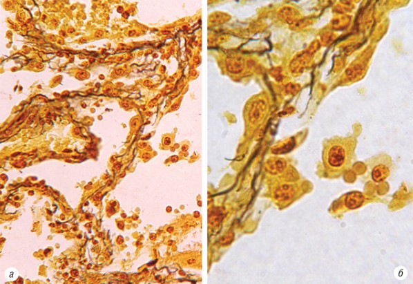 Рис. 6. Препарат умереннодифференцированного плоскоклеточного рака легкого. Среди пролиферирующего альвеолярного эпителия единичные опухолевые клетки, растущие от базальной мембраны. Окраска по W. Howell, D. Black; х200 (а); х1000 (б)