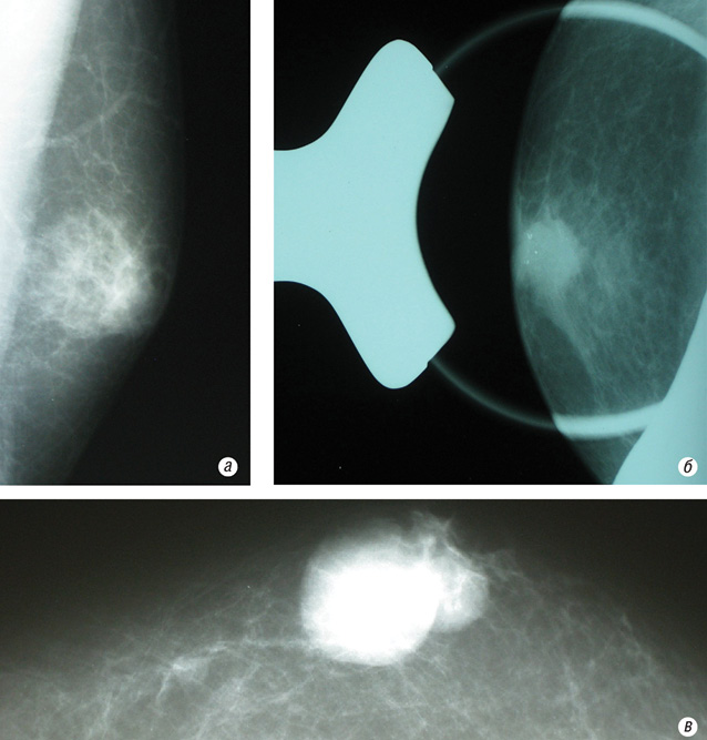 Рис. 11. Рентгенограммы рака грудной железы у мужчины, пациент Р., 1954 г.р. (а — косая проекция, б — прицельный снимок, в — прямая проекция).