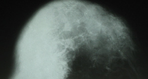 Рис. 15. Рентгенограмма лимфомы правой грудной железы пациентки П., 1973 г.р. через 2,5 года (контрольное исследование)