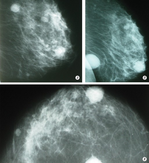 Рис. 16. Рентгенограммы метастазов меланомы в обе грудные железы  пациентки Н., 1967 г.р. Диагноз был верифицирован после удаления узловых образований в грудных железах, поскольку пункционная биопсия при данной злокачественной нозологической форме может привести к диссеминации процесса