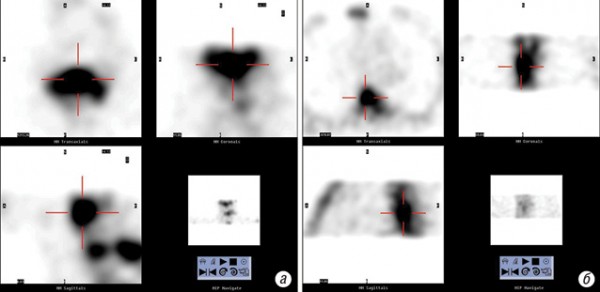 Рис. 1. ОФЕКТ при злоякісних змінах у хребті ( а — ОФЕКТ шийного відділу хребта: на аксіальних та фронтальних зрізах С5 зона інтенсивної гіперфіксації РФП візуалізується в тілі хребця з розповсюдженням на обидві ніжки; б — ОФЕКТ грудного відділу хребта: на аксіальних зрізах Th4 чітко візуалізується зона гіперфіксації  РФП в тілі хребця з розповсюдженням на ліву ніжку)