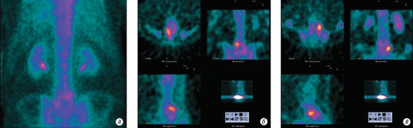 Рис. 3. ОФЕКТ при доброякісних змінах у хребті. На задній планарній проекції (а) виявлено 2 ділянки інтенсивно підвищеної фіксації РФП — в L5 та на межі  L5-S1 ліворуч. При ОФЕКТ на аксіальних, фронтальних та сагітальних зрізах на рівні L5-S1 ліворуч (б) зона гіперфіксації РФП локалізується в латеральному відділі і попереду тіла хребця на рівні міжхребцевого диску, що  відповідає дегенеративним  змінам зі склеротичним перетворенням замикаючих пластинок тіл хребців і кістковим розростанням по їх контурах з утворенням остеофітів. На аксіальних, фронтальних та сагітальних зрізах L5 (в) зона гіперфіксації РФП овальної форми, розташована одразу позаду тіла хребця на рівні його правої дуги. Така локалізація відповідає спондилолізу