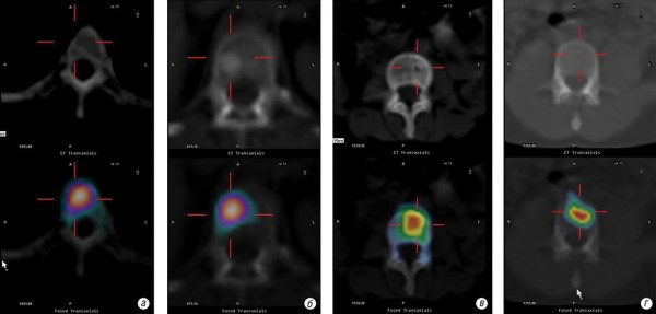 Рис. 2. ОФЕКТ/КТ  при злоякісному ураженні хребта (а — літичне вогнище; б — склеротичне вогнище; в — змішане вогнище і Г — невизначене вогнище)