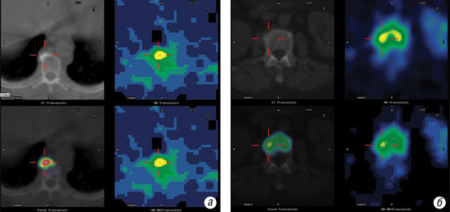 Рис. 4. ОФЕКТ/КТ при доброякісних змінах у хребті. а — на аксіальному зрізі ділянка гіперфіксації  РФП чітко локалізується попереду тіла хребця, що відповідає «гарячому» остеофіту. б — ділянка гіперфіксації розташована на рівні міжхребцевого диску і співпадає з регіонами дегенеративних склеротичних змін диску та замикаючих пластинок тіл хребців