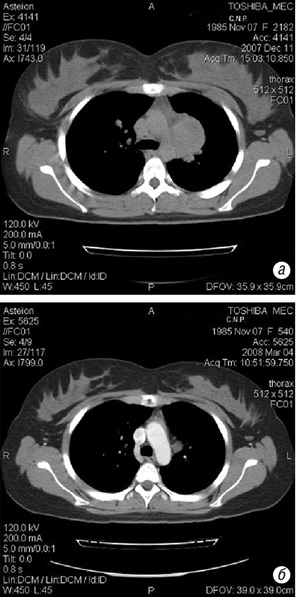 Рис. 2. Комп’ютерні томограми органів грудної порожнини хворої Ч., а — до лікування, б — після 3 циклів ПХТ за протоколом ЕМА-ЕР на фоні РГТ