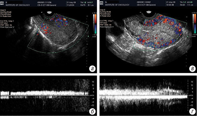 Рис. 3. Зміни кровотоку в матці хворої зі злоякісною трофобластичною пухлиною після проведення РГТ: а, б — сонограми матки з пухлиною в В режимі з кольоровим картуванням і допплерограма кровотоку до сеансу РГТ; в, г — сонограми матки з пухлиною в В режимі з кольоровим картуванням і допплерограма кровотоку після сеансу РГТ