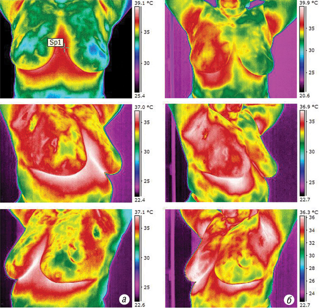 Рис. 2. Термограми хворої К. до (а) та після (б) проведення сеансу РГТ (підвищення температури на 3,5°С.)