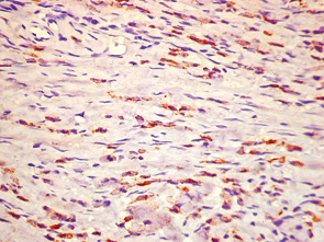 Рис. 13. Сохранение экспрессии панцитокератина АЕ1/АЕ3 в фибробластоподобных опухолевых клетках. Ув. 400