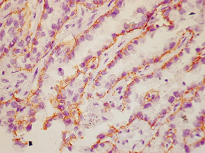 Рис. 7. Экспрессия Е-кадгерина преимущественно в базальном полюсе клеток бронхиоло-альвеолярного рака. Ув. 400