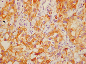 Рис. 8. Выраженная экспрессия маркера макрофагов CD68 в опухолевых клетках крупноклеточного рака легкого. Ув. 400