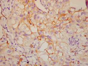 Рис. 9. Сохранение мембранной экспрессии Е-кадгерина в крупноклеточном раке легкого с макрофагальной дифференцировкой опухолевых кле­ток. Ув. 400