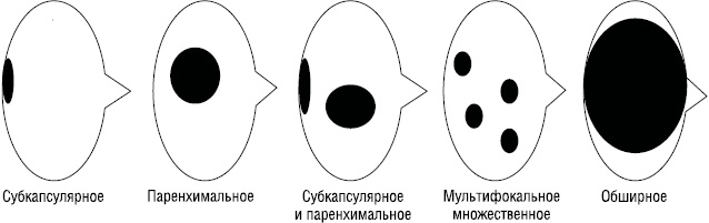 Рис. 2. Микроанатомическая локализация метастазов в «сторожевом» лимфатическом узле