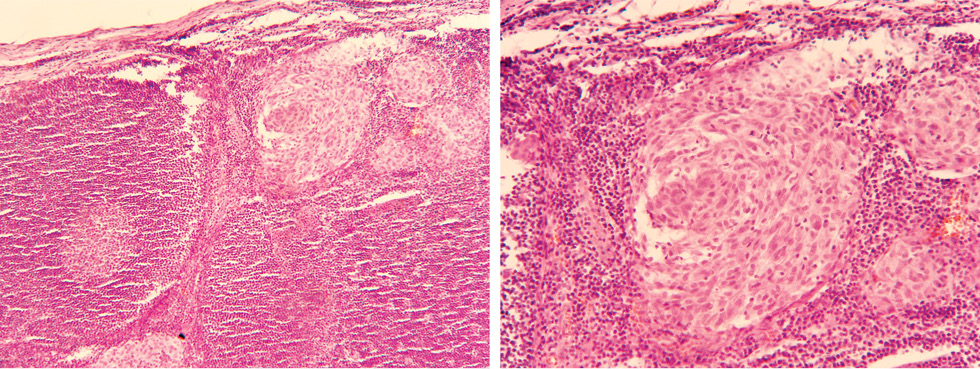 Рис. 1. Микрометастазы меланомы кожи в лимфатическом узле. Микропрепарат, окраска гематоксилином и эозином