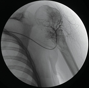 Рис. 3. Антеградная катетеризация левой плечевой артерии доступом че­рез бедренную артерию. Остеосаркома плечевой кости. Периферическая артериография. Дезорганизация сосудистого рисунка опухоли