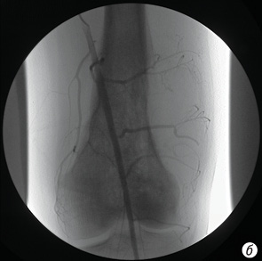 Рис. 6. Исходная артериограмма левой бедренной кости. а — остеосаркома. Поздняя артериальная фаза контрастирования. Высокий уровень интенсивности развития опухолевой неоваскуляризации (+++); б — периферическая артериография того же больного, выполненная после 4 курсов внутриартериальной химиотерапии. Значительная редукция опухолевой неоваскуляризации, составляющая не менее 90% ее объема