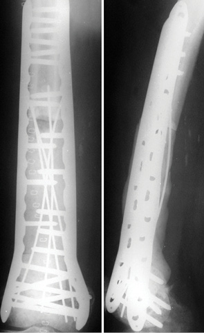 Рис. 10. Фотоотпечатки рентгенограммы правого бедра пациента О. (59 лет) после операции