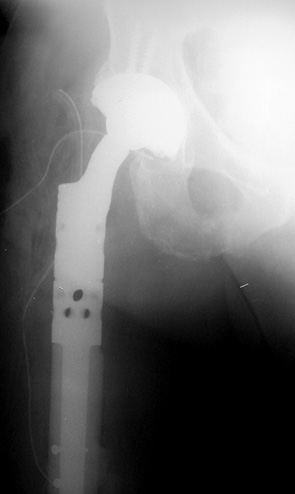 Рис. 2. Фотоотпечатки рентгенограм­мы проксимального отдела правого бедра пациента А. (60 лет) после операции