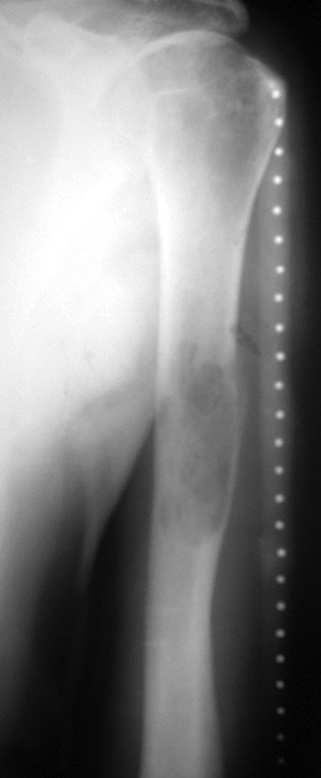 Рис. 3. Фотоотпечаток рентгенограм­мы правого плеча пациента Х. (50 лет) до операции