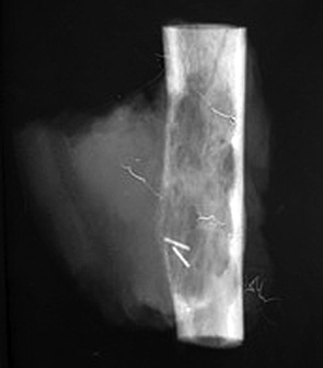 Рис. 4. Фотоотпечаток рентгенограм­мы удаленного препарата опухоли плечевой кости